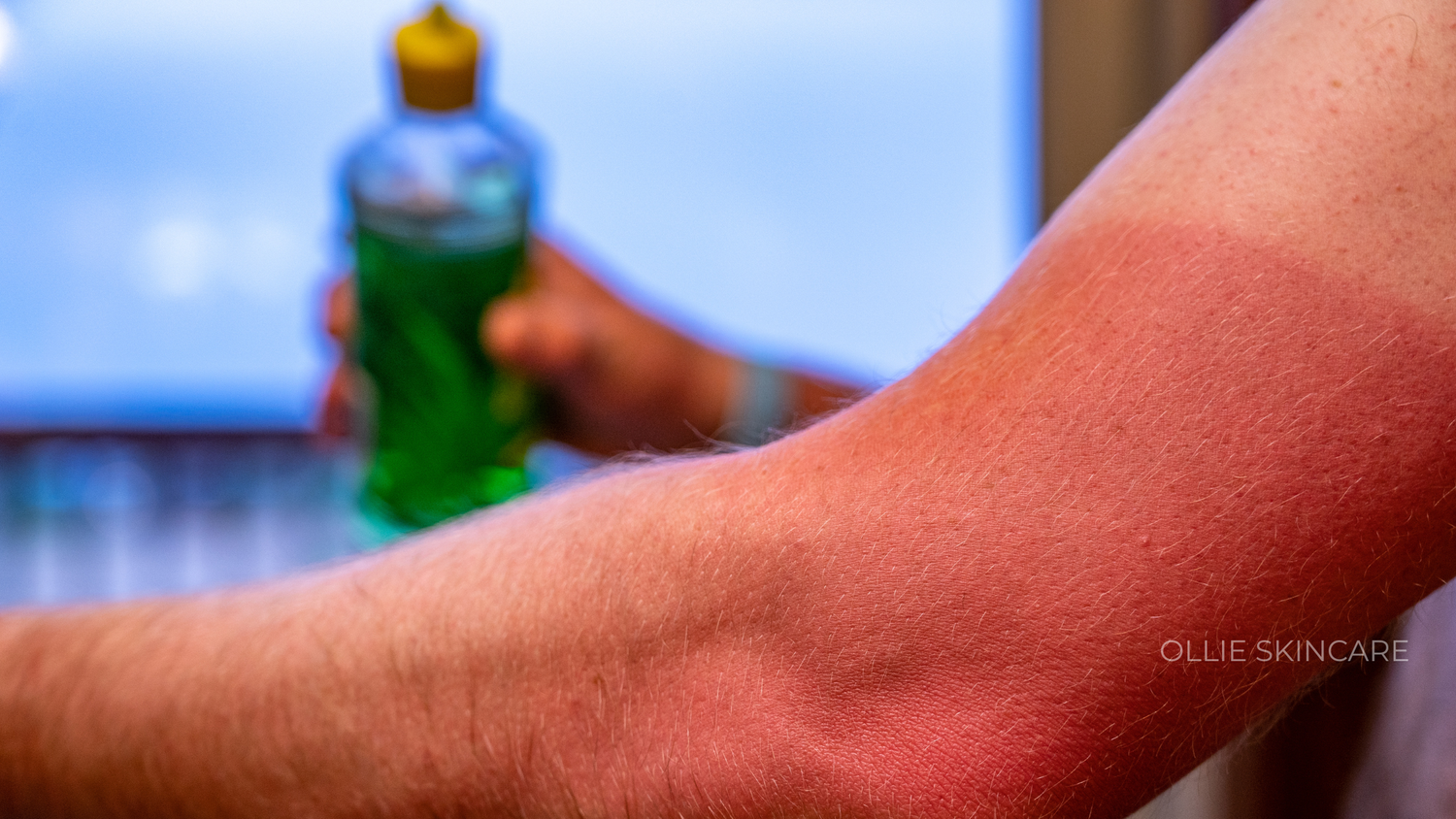 Arm Sunburn