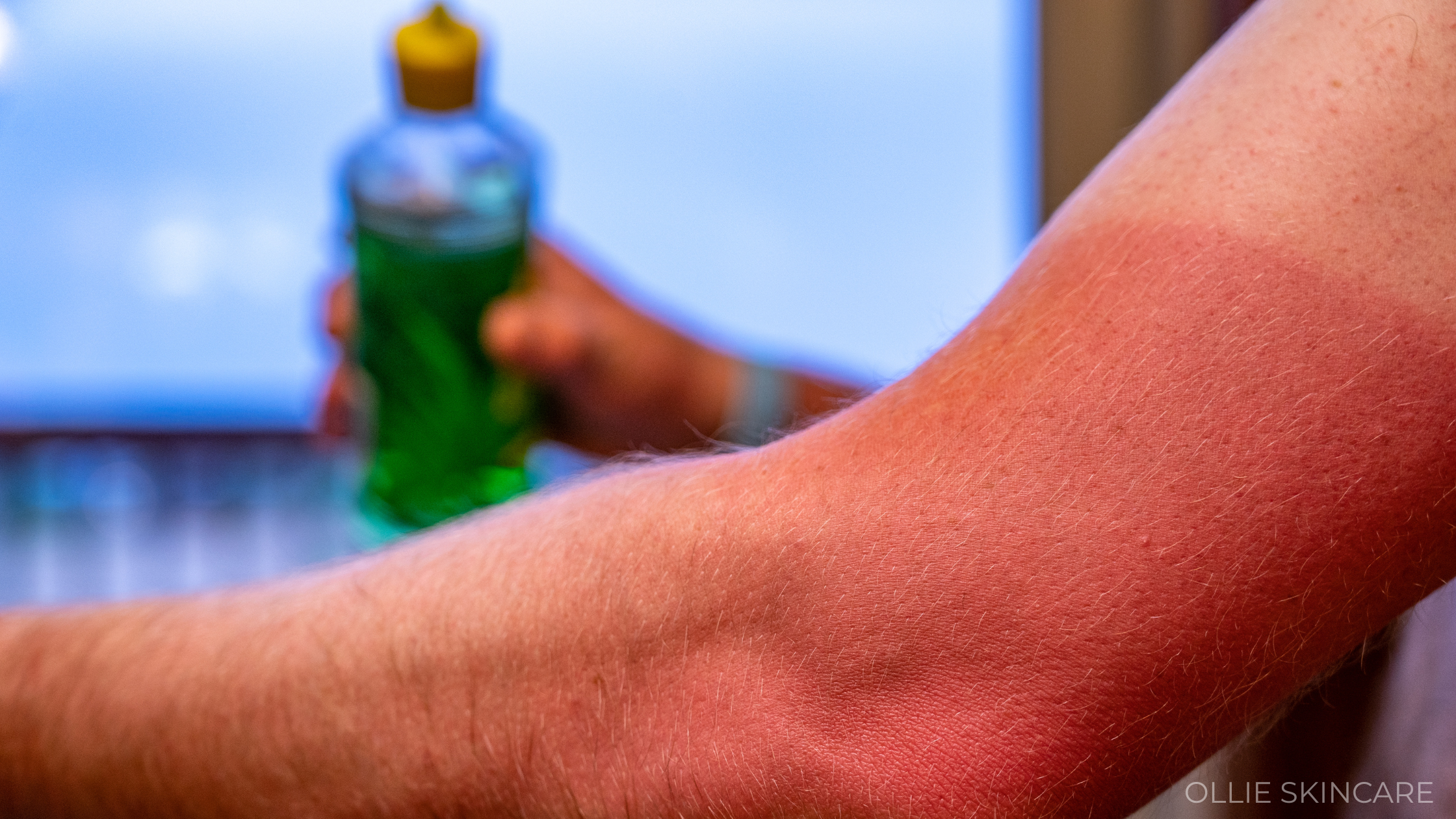Sunburn 101: What Actually Helps, and When to Call a Doctor