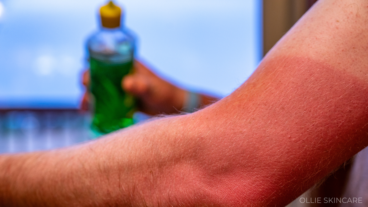 Blog banner: How to treat sunburn at home