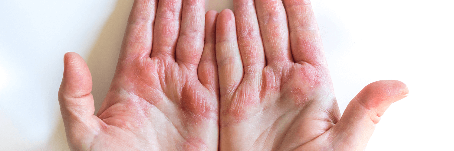 Uncovering the Benefits of Using the Best Goat Milk Soap for Eczema - hands with eczema and irritation